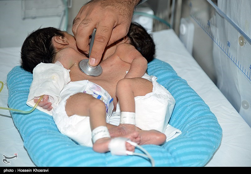 تولد دوقلوهای به هم چسبیده - شیراز