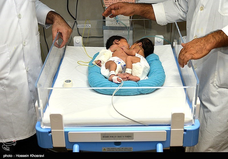 تولد دوقلوهای به هم چسبیده - شیراز
