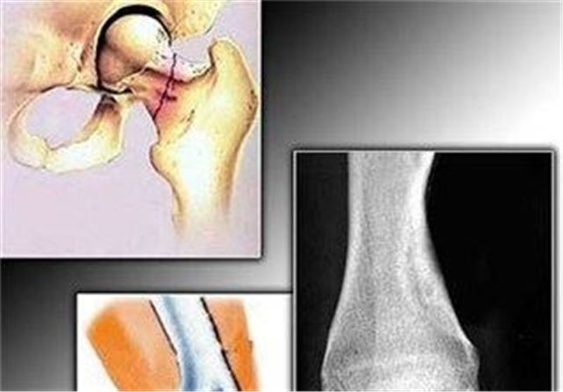 درک فعالیت نوعی گیرنده در پیشرفت آرتروز به رهبری دانشمند ایرانی