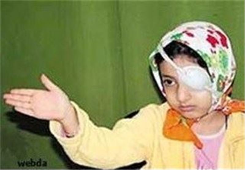 طرح غربالگری تنبلی چشم در زنجان آغاز می‌شود