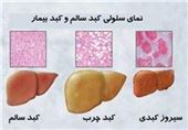 اکثر ایرانیان به دلیل رژیم غذایی نامناسب به کبد چرب مبتلا می‌شوند