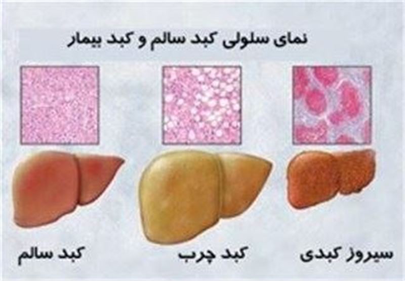 اکثر ایرانیان به دلیل رژیم غذایی نامناسب به کبد چرب مبتلا می‌شوند