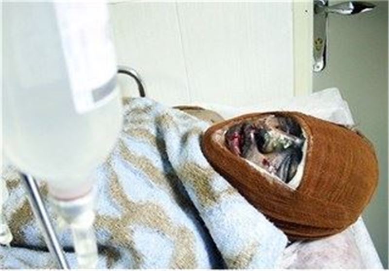 روزی 10 بیمار سوختگی در ایران می‌میرند