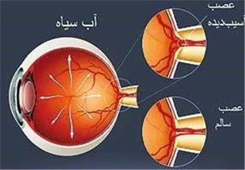 درمان آسیب‌های سطحی چشم با استفاده از سلول‌های بنیادی