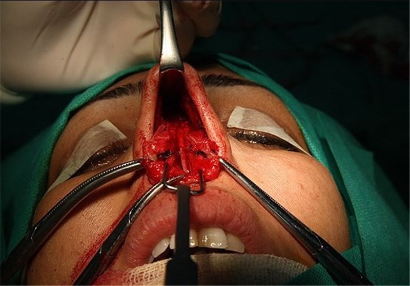 80 درصد جراحی‌های زیبایی به انحراف بینی مبتلا هستند