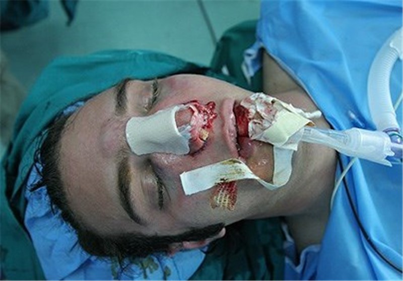 «آمبولی ریه» علت مرگ دختر جوان همدانی پس از جراحی بینی