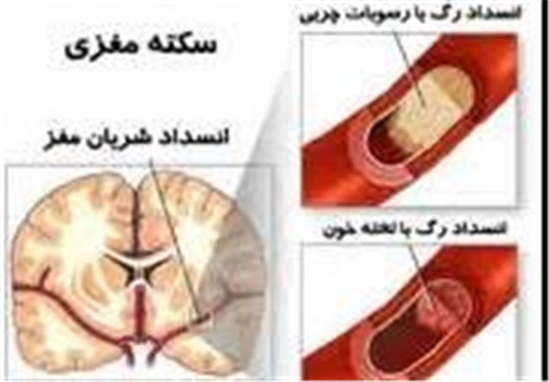 روزانه 300 نفر در کشور دچار سکته مغزی می‌شوند/افزایش سکته‌های مغزی در ایران