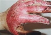 سوختگی جوان نوشهری