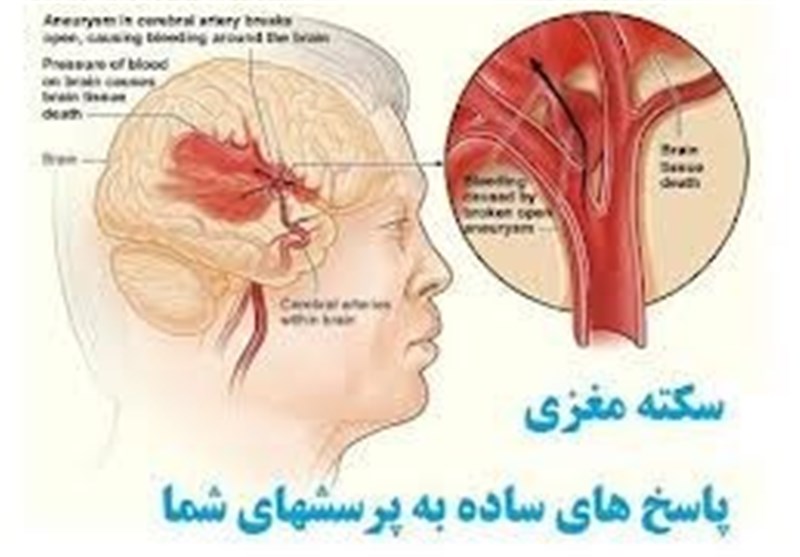 طرحی برای کاهش روزانه 300 سکته مغزی در ایران