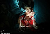 اهدای عضو بانوی نهاوندی جان چند بیمار را نجات داد
