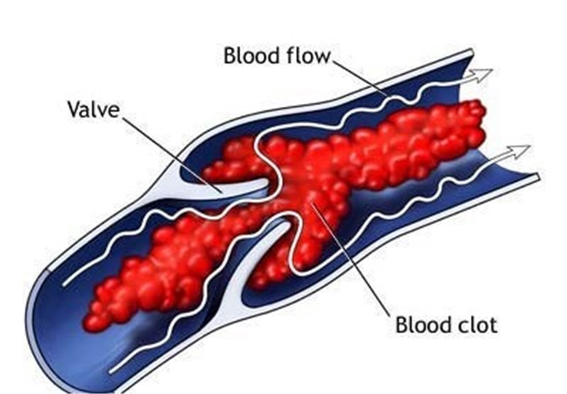 Surprise Finding: Blood Clots Absorb Bacterial Toxin