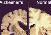 Predicting Change in Alzheimer&apos;s Brain