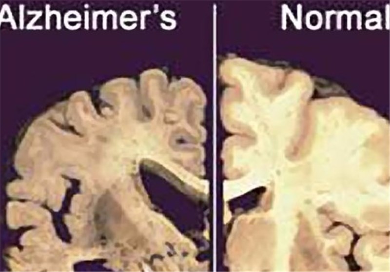 Predicting Change in Alzheimer&apos;s Brain