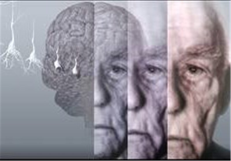 سرعت راه رفتن راهی برای تشخیص آلزایمر