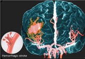 پیش‌بینی خطر مرگ بیماران سکته مغزی از طریق چشم