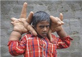 تصاویر پسر هندی با دستانی غول آسا