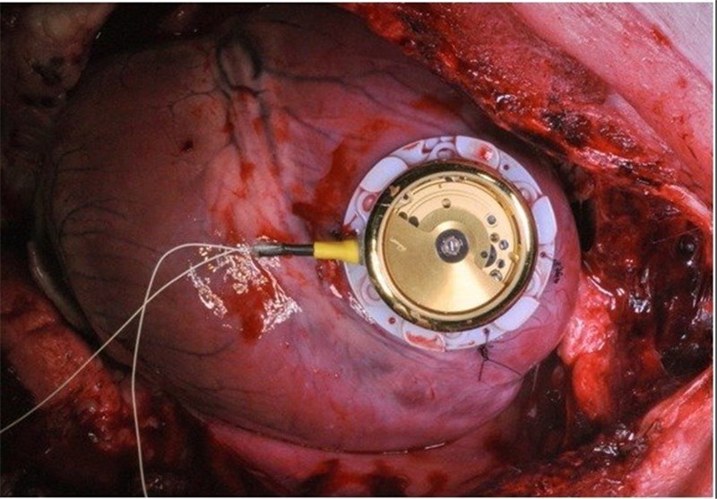 تعبیه دریچه شریان ریوی بدون عمل جراحی قلب از طریق ورید کشاله ران