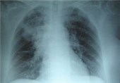 Cystic Fibrosis Lung Infection: Scientists Open Black Box on Bacterial Growth