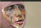 اختلافات خانوادگی در رفسنجان به اسیدپاشی منجر شد