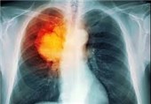 ساخت حسگر تشخیص سرطان ریه و روده توسط پژوهشگران برق کشور