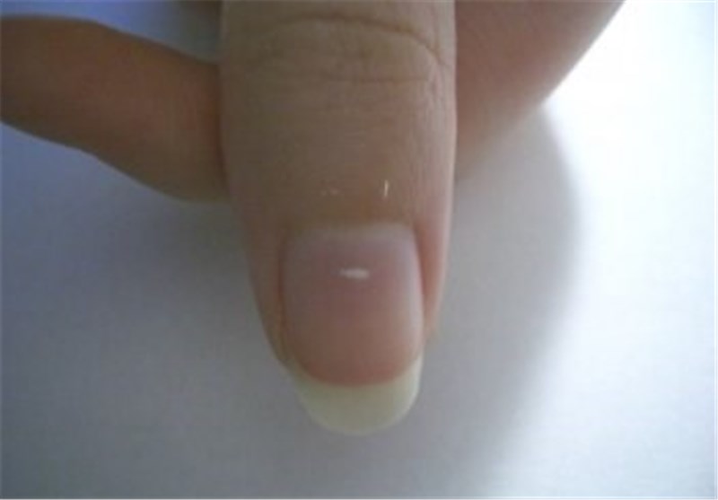 علت بروز لکه‌های سفید روی ناخن‌