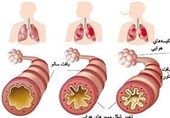 بیماری آسم و توصیه‌های طب سنتی