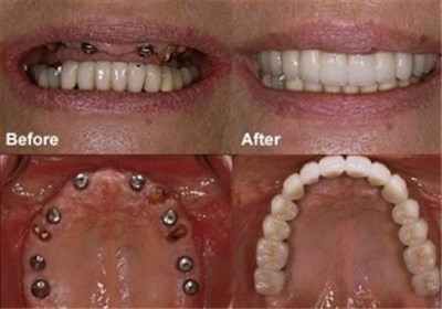  فریب مردم به اسم "ایمپلنت کامل دندان" در یک روز! 