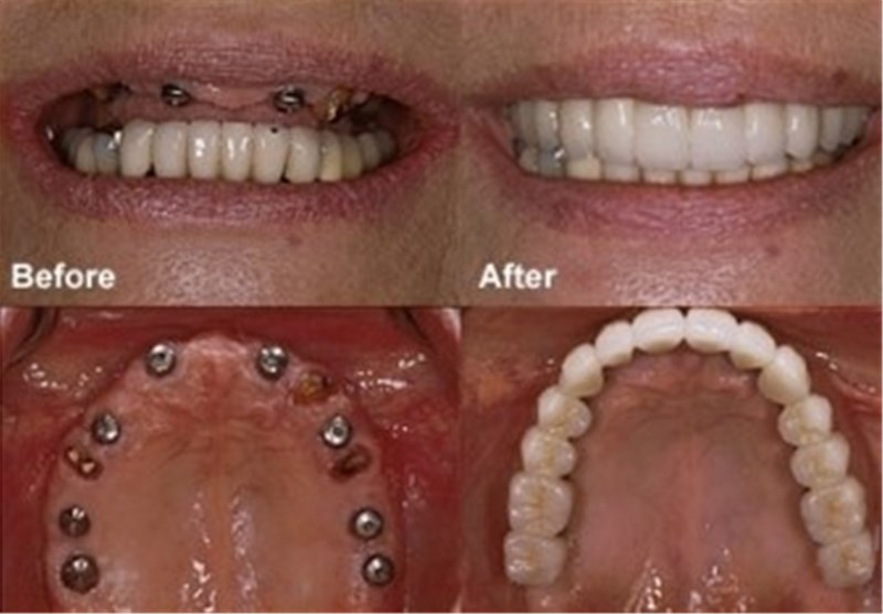 تولید نخستین ایمپلنت‌ دندان ایرانی