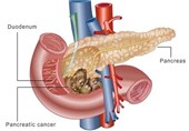 Important Steps toward Developing Blood Test to Catch Pancreatic Cancer Early