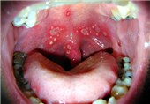 عدم رعایت بهداشت دهان و دندان، یک عامل بروز سرطان غدد بزاقی