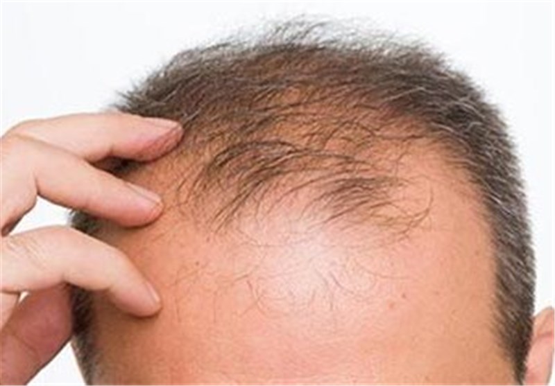 بررسی تأثیر مکمل بیوتین در جلوگیری از ریزش مو