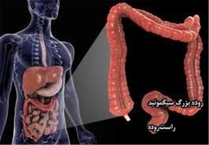 سرطان «روده بزرگ» در ایران دیگر زود تشخیص داده خواهد شد