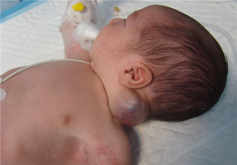 انجام عمل جراحی نادر تومور گردن کودک 4 روزه در کرج+ تصاویر