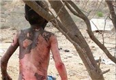 کودکان سوخته یمنی در حملات سعودی در استان حجه + عکس