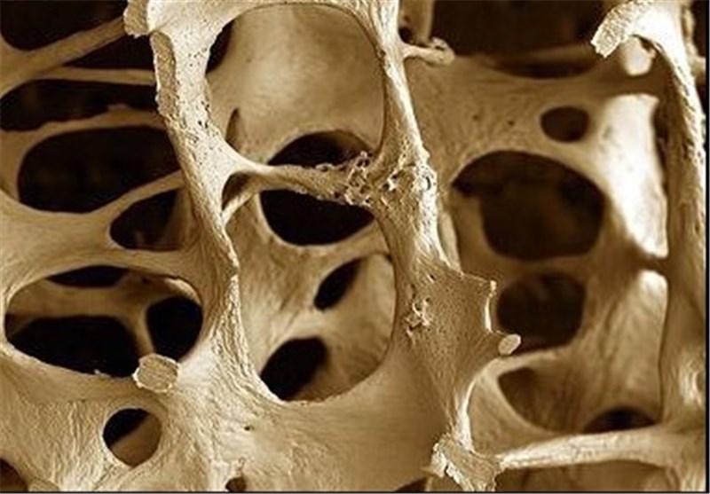 علائم مخفی پوکی استخوان چیست؟