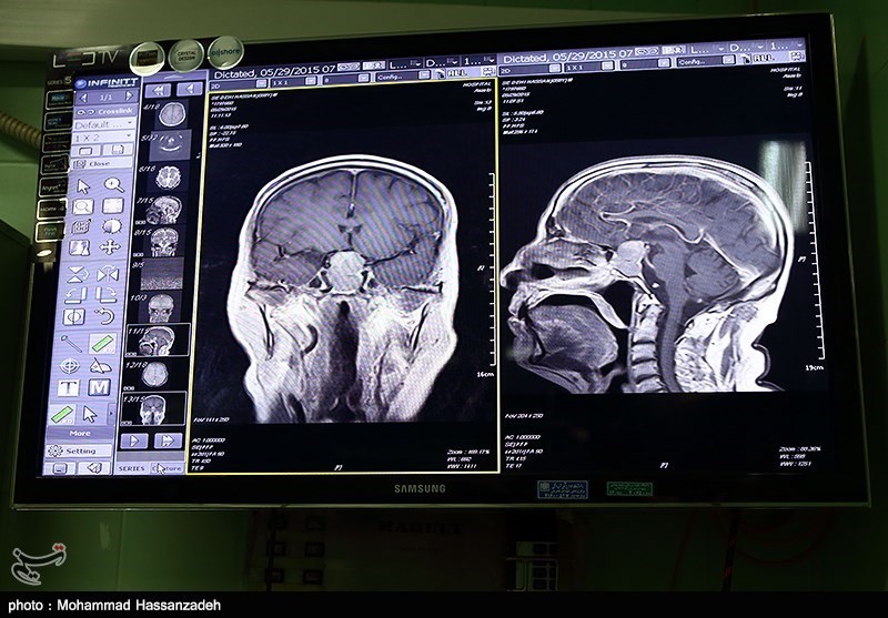 Brain Tumor Characteristics Could Help Predict Survival in People over 70