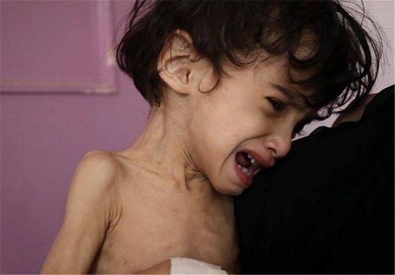 تصاویری تکان‌ دهنده از سوء تغذیه کودکان یمنی