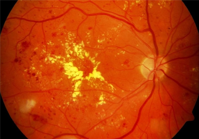 Injection Instead of Laser May Be Viable Treatment Option for Diabetic Retinopathy