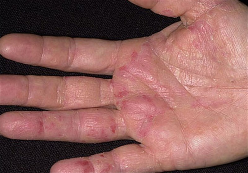 تدابیر تغذیه رفع کهیر از منظر طب سنتی