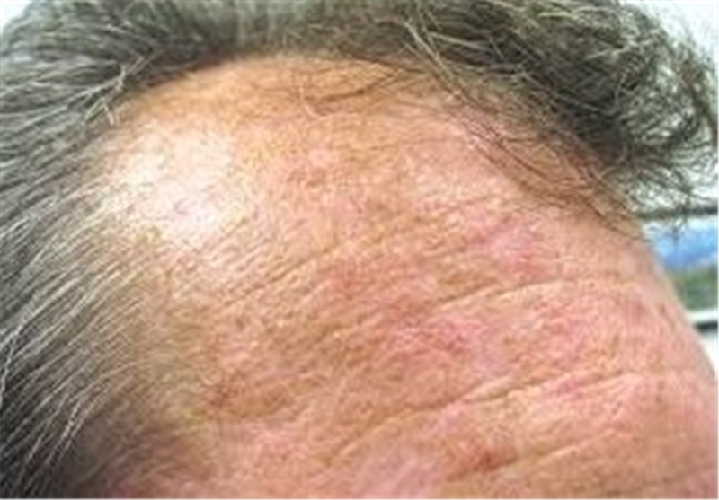 First Topical Treatment for Common Benign Skin Lesions