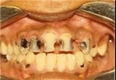 اپیدمی داشتن دندانهای درشت و بیش از حد سفید در ایران