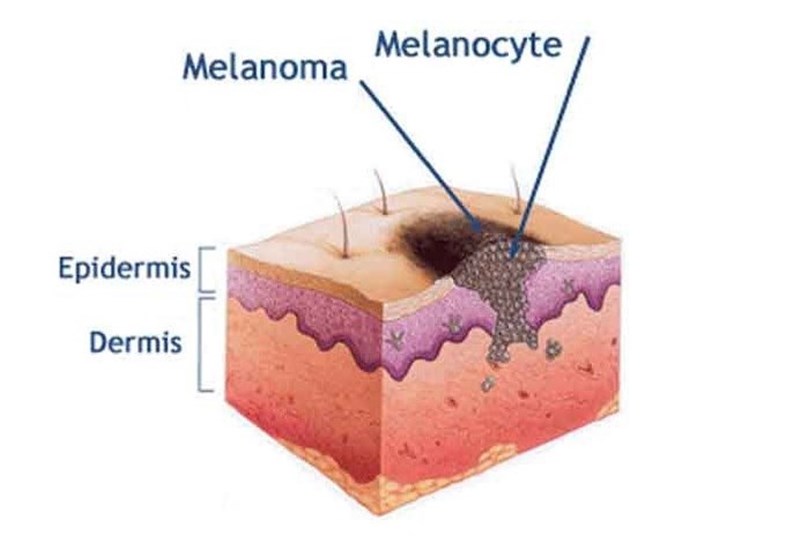 Skin Cancer: New Drugs with Surprising Powers