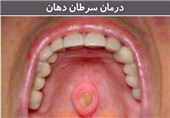 تومورهای حفره دهان به دلیل افزایش آلودگی هوا