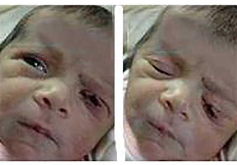 &quot;ناخن&quot; نوزاد عامل پارگی پلک چشم هنگام تولد/ علت دقیق حادثه در دست بررسی است‌