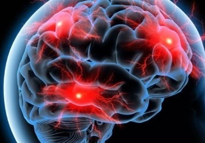 آلزايمر،بيمار،زودهنگام،علائم،تزريق،مغز