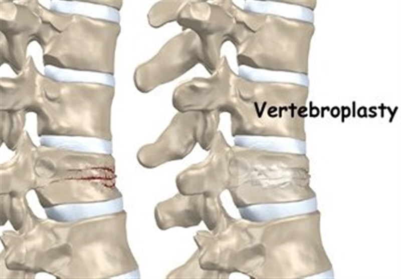 Vertebroplasty Helps Reduce Acute Pain among Patients with Spinal Fractures