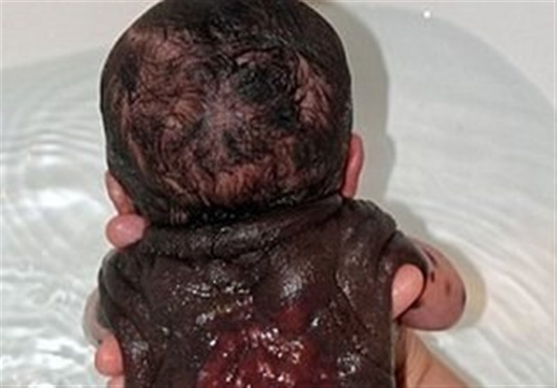 نوزاد خال‌پشتی که 26 بار جراحی شد! + تصاویر