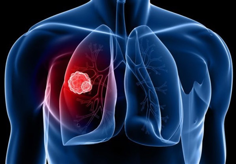 Lung Cancer Risk Drops Substantially within Five Years of Quitting: Study
