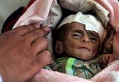 الامم المتحدة: ملیونان و200 ألف طفل یمنی یعانون من سوء تغذیة حاد