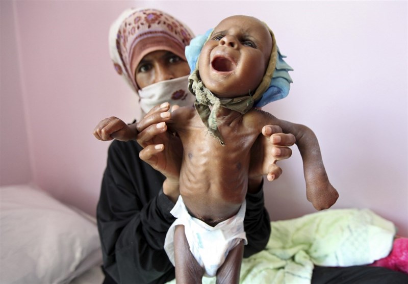 یونیسف: یک‌میلیون و 800 هزار کودک یمنی از سوء‌تغذیه شدید رنج می‌برند